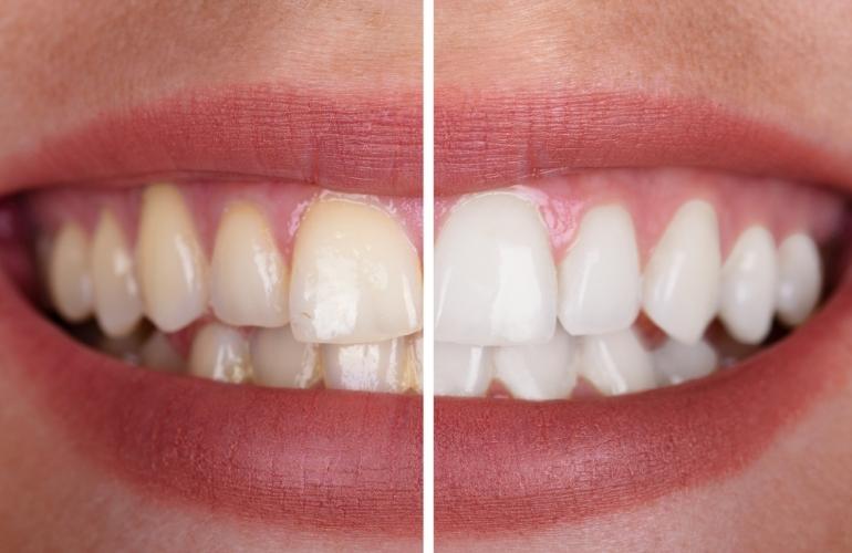 tooth whitening