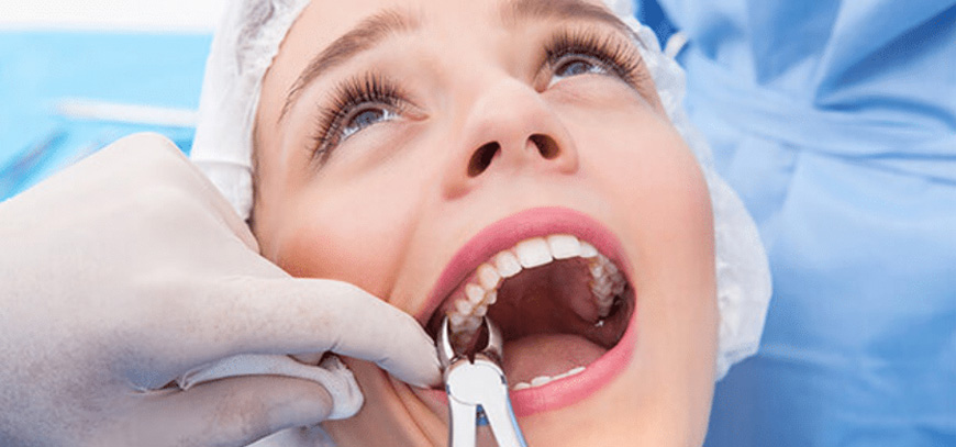 teeth extraction