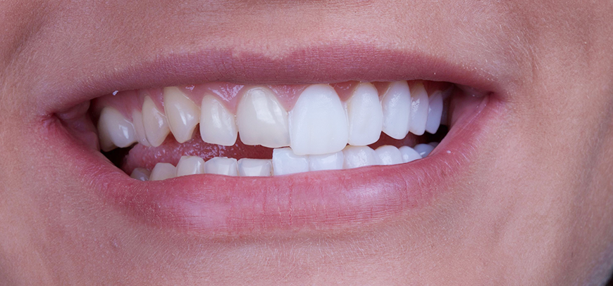 veneers