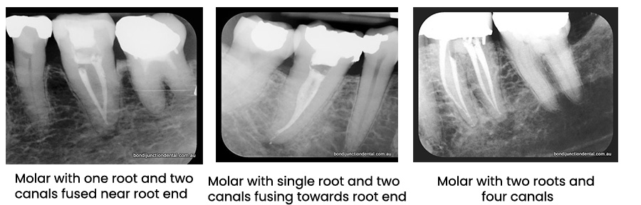 root 1