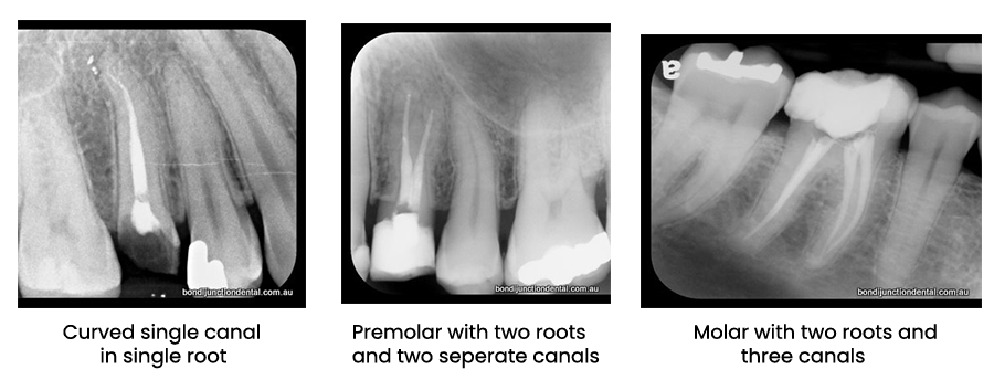 root canal